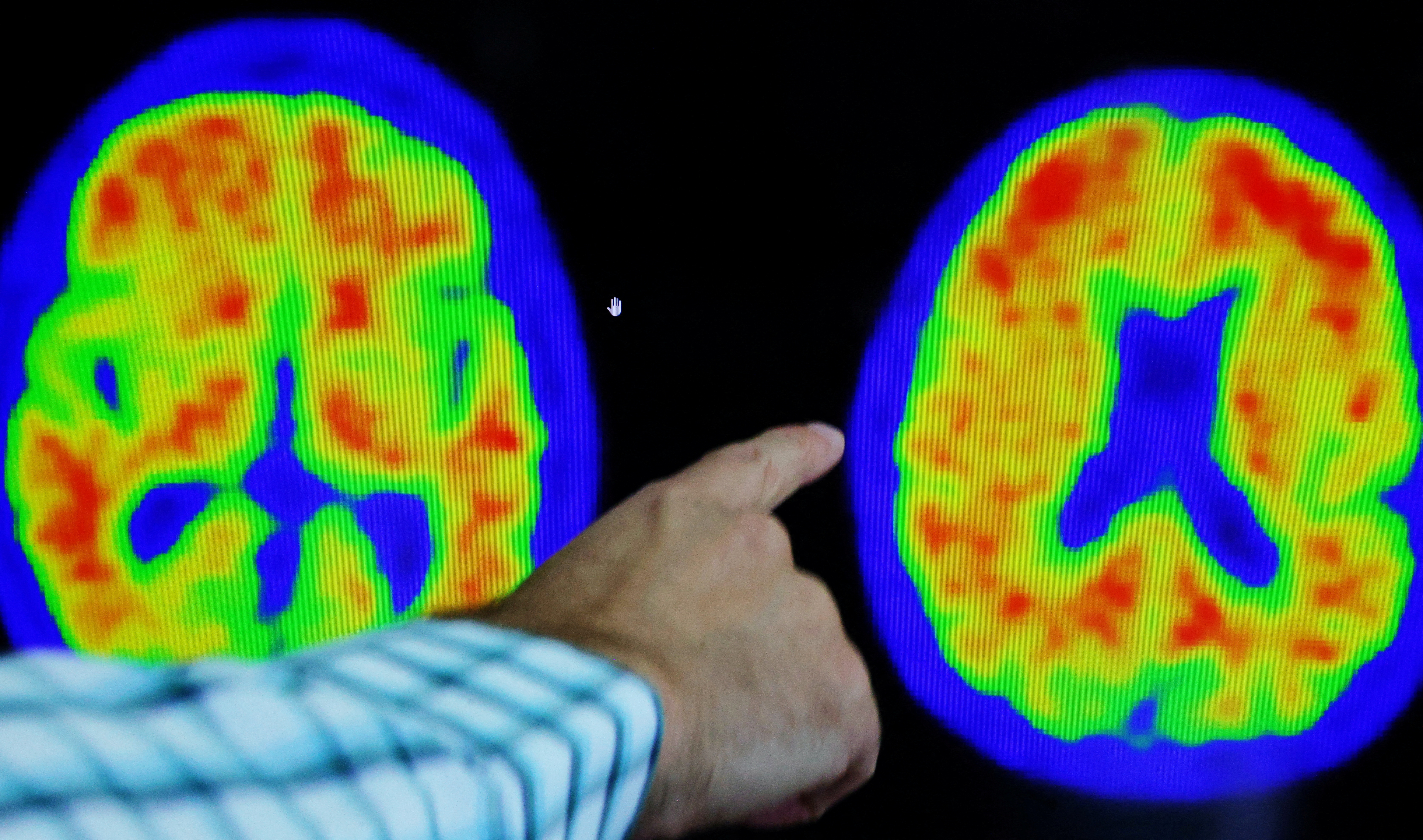 Inside the hunt for an Alzheimer's disease vaccine