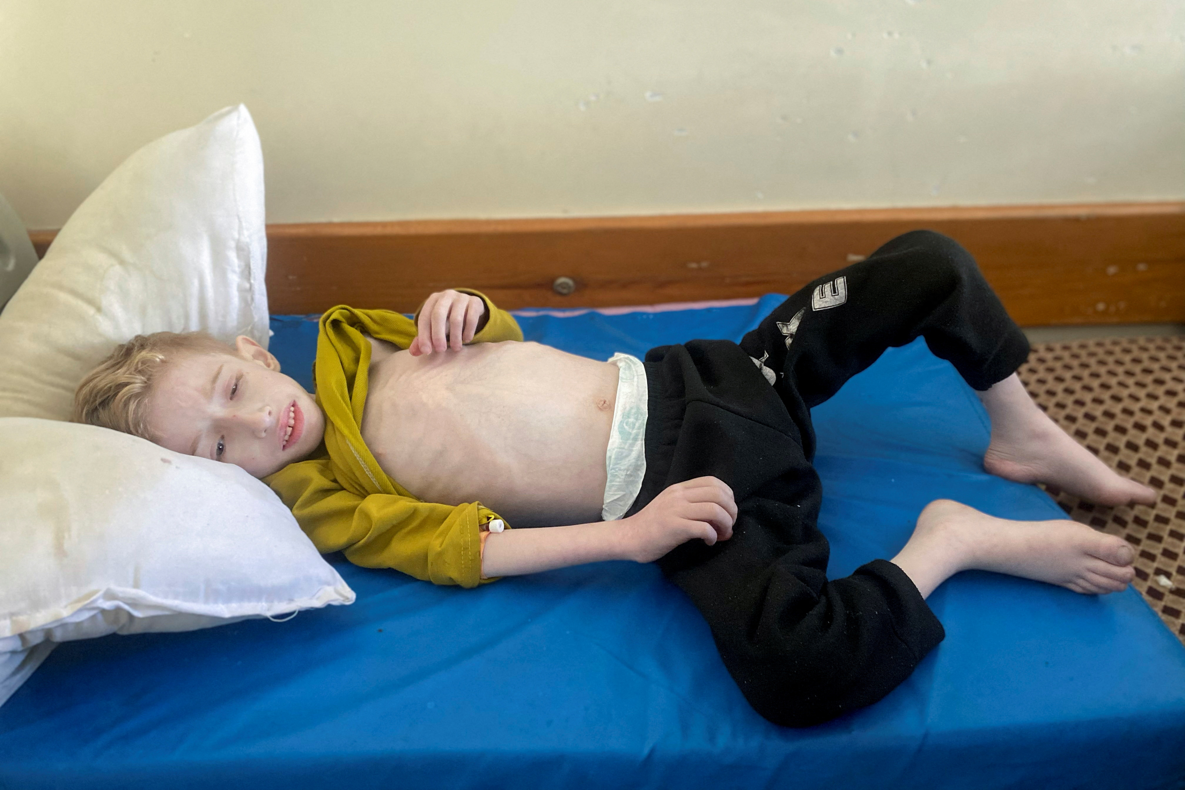 Malnourished Palestinian boy Fadi al-Zant lies on a bed at Kamal Adwan hospital, amid the ongoing conflict between Israel and Hamas, in northern Gaza
