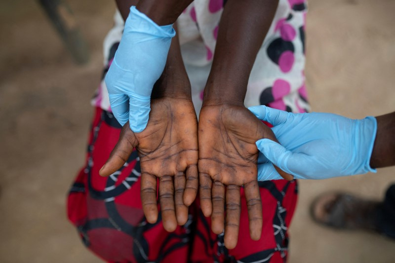 Monkeypox treatment trial begins in the Democratic Republic of the Congo