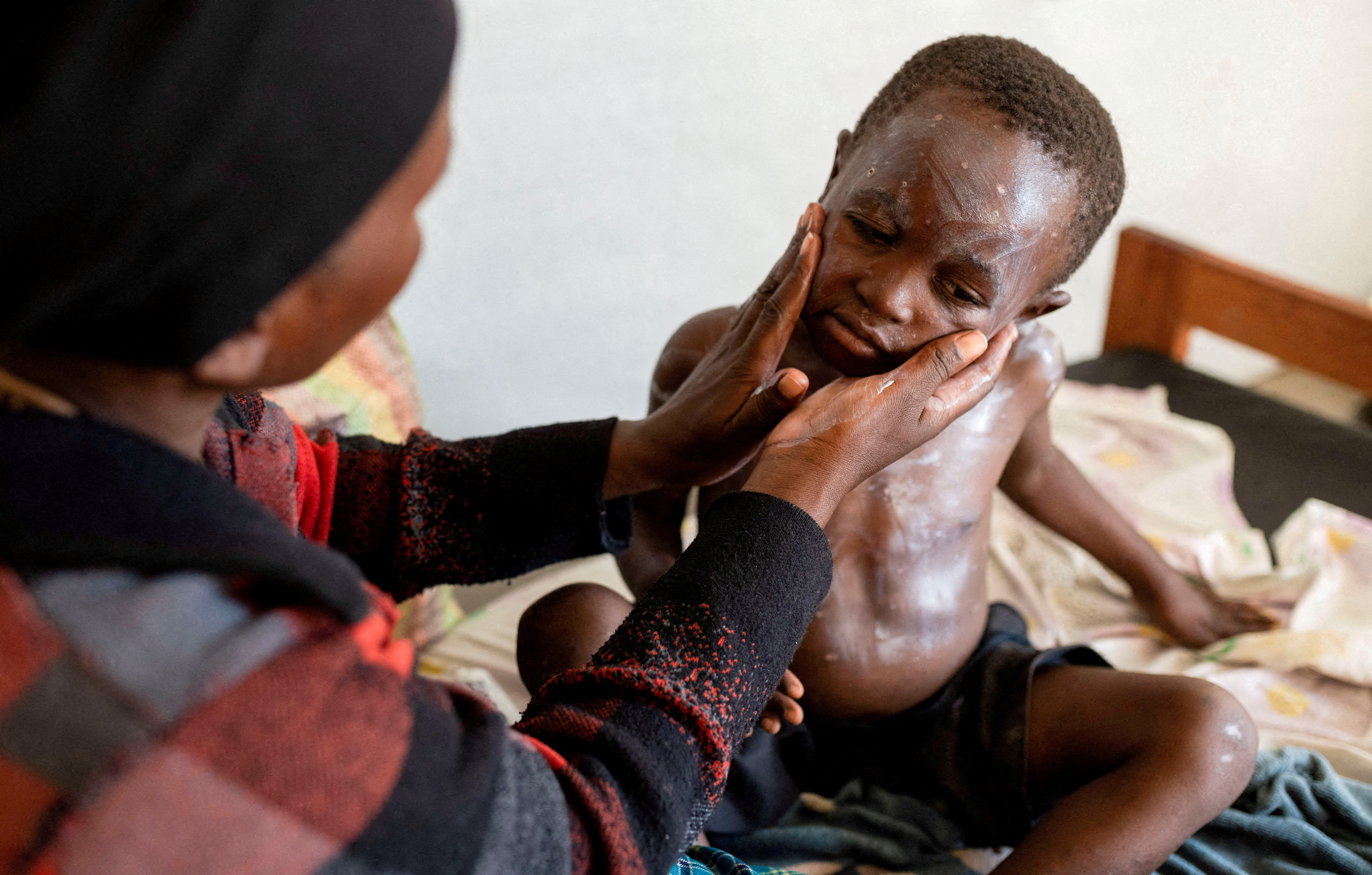 Furaha Elisabeth applies medication on the skin of her child Sagesse Hakizimana who is under treatment against Mpox in Munigi