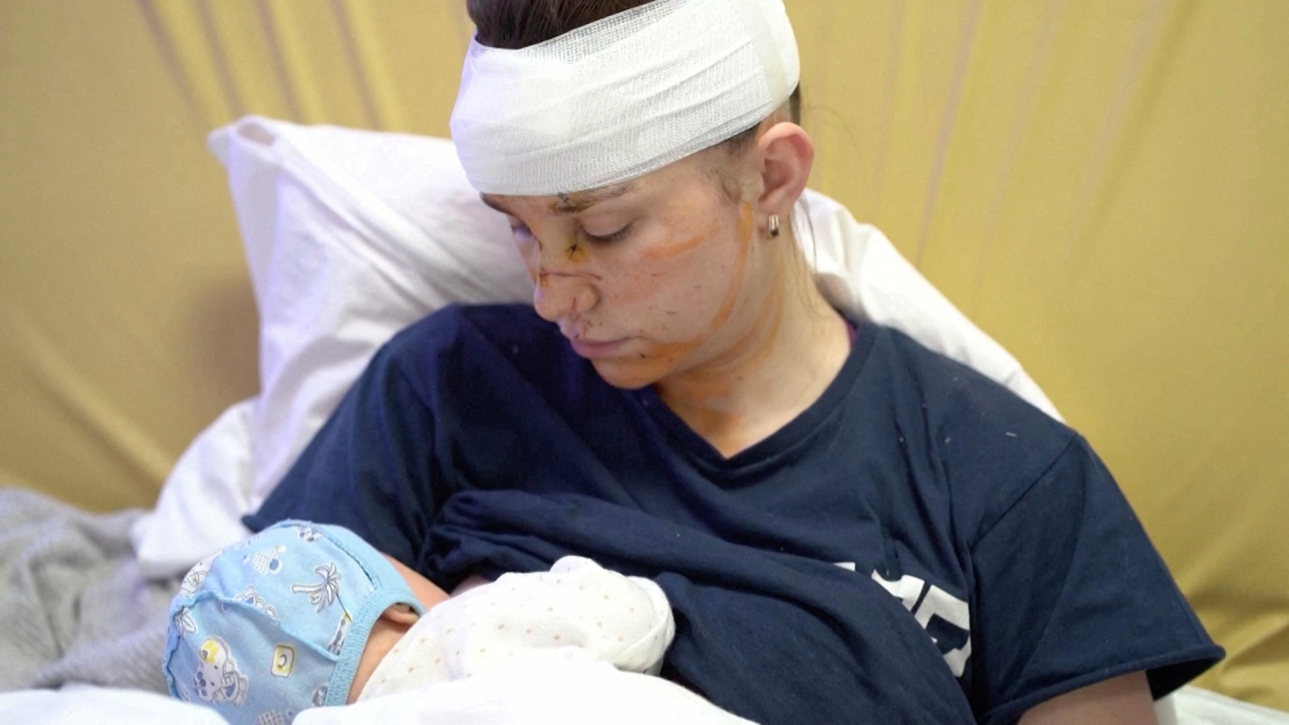 Olga, a 27-year-old Ukrainian woman seriously wounded while sheltering her baby from shrapnel blasts amid Russia's ongoing invasion of Ukraine, holds her baby Victoria in Kyiv