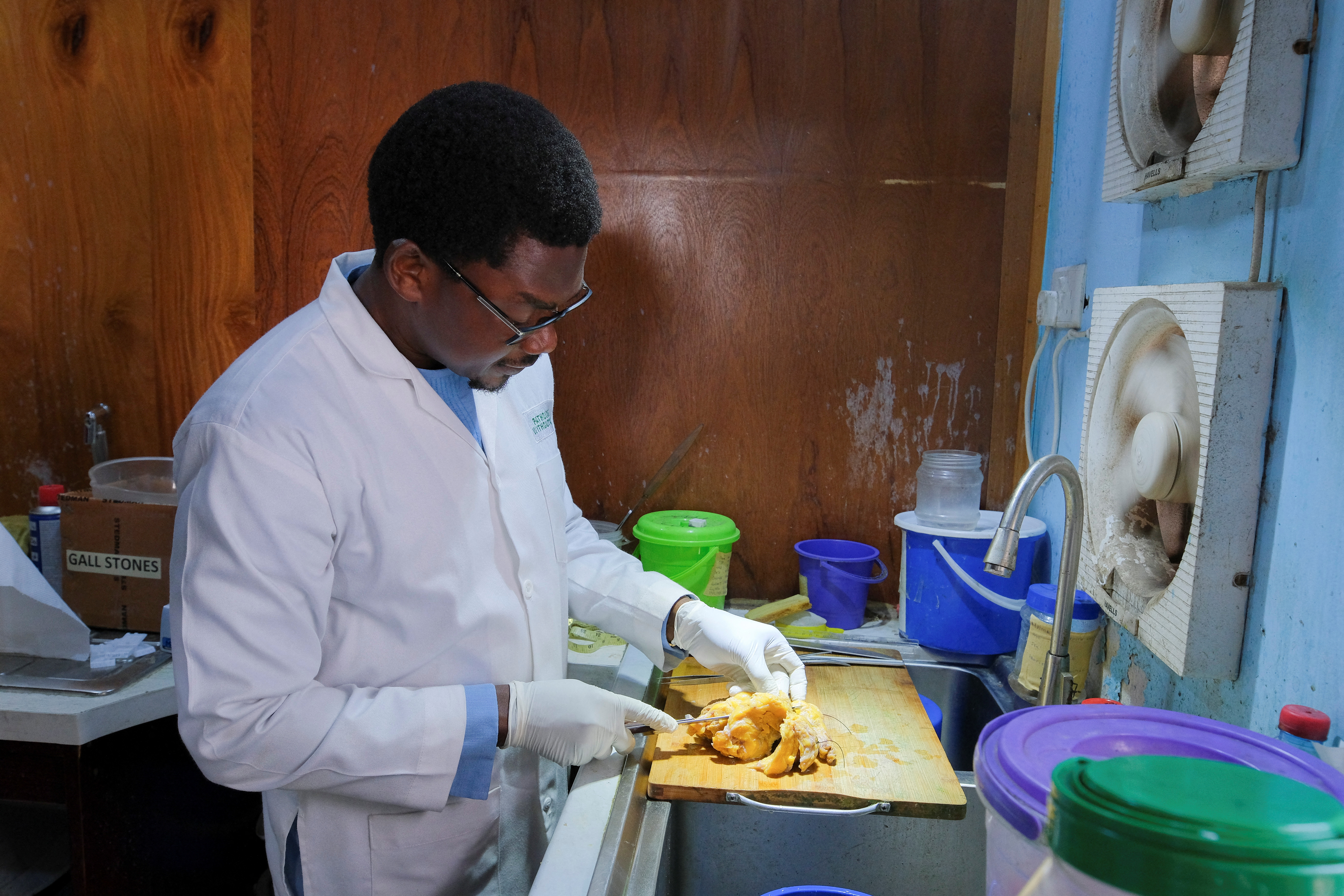 Dr. Kafui Akakpo, a pathologist, observes a breast lump with a tumour at the Pathologists Without Borders laboratory in Accra