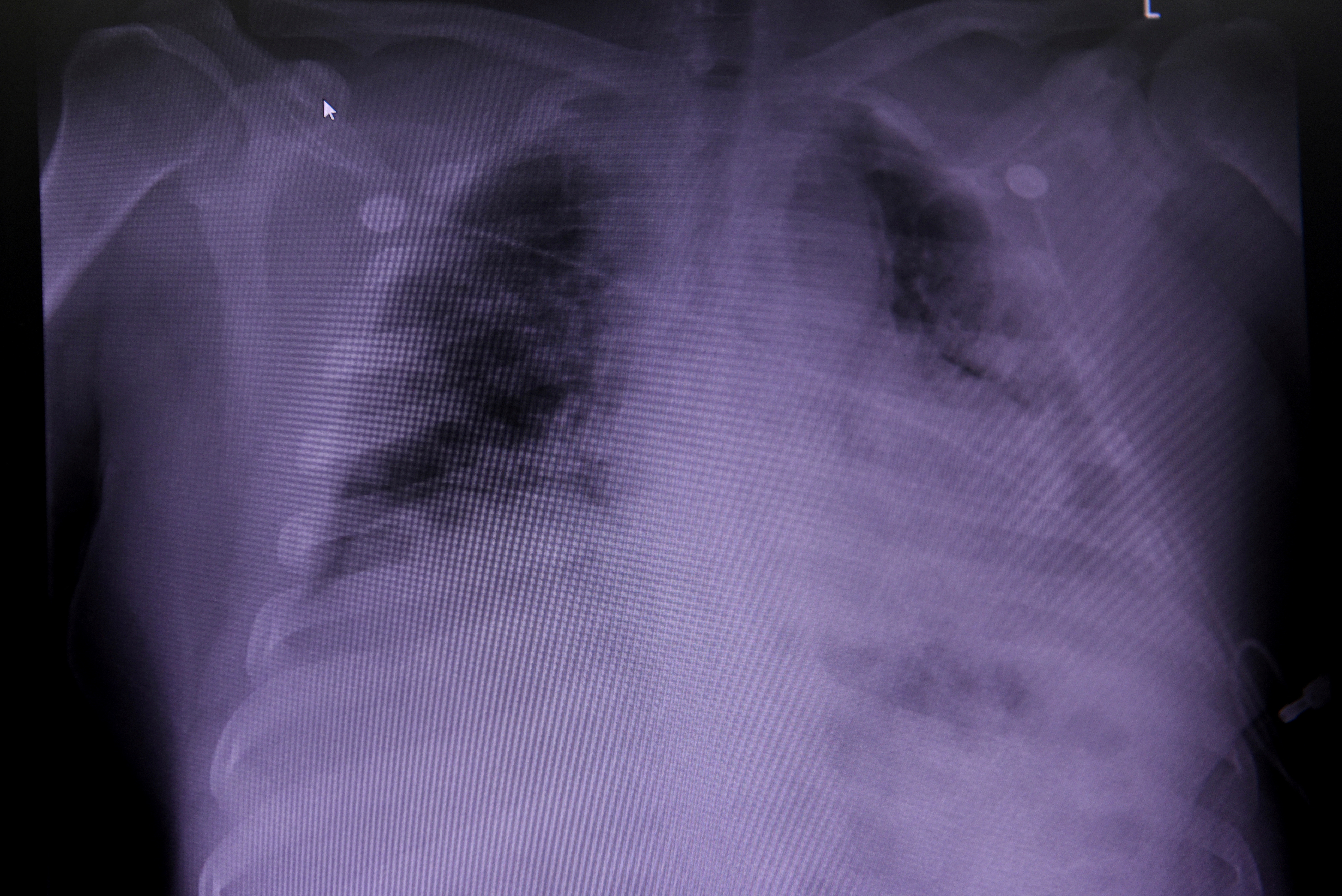An X-ray of a COVID-19 patient's lungs in Houston, Texas