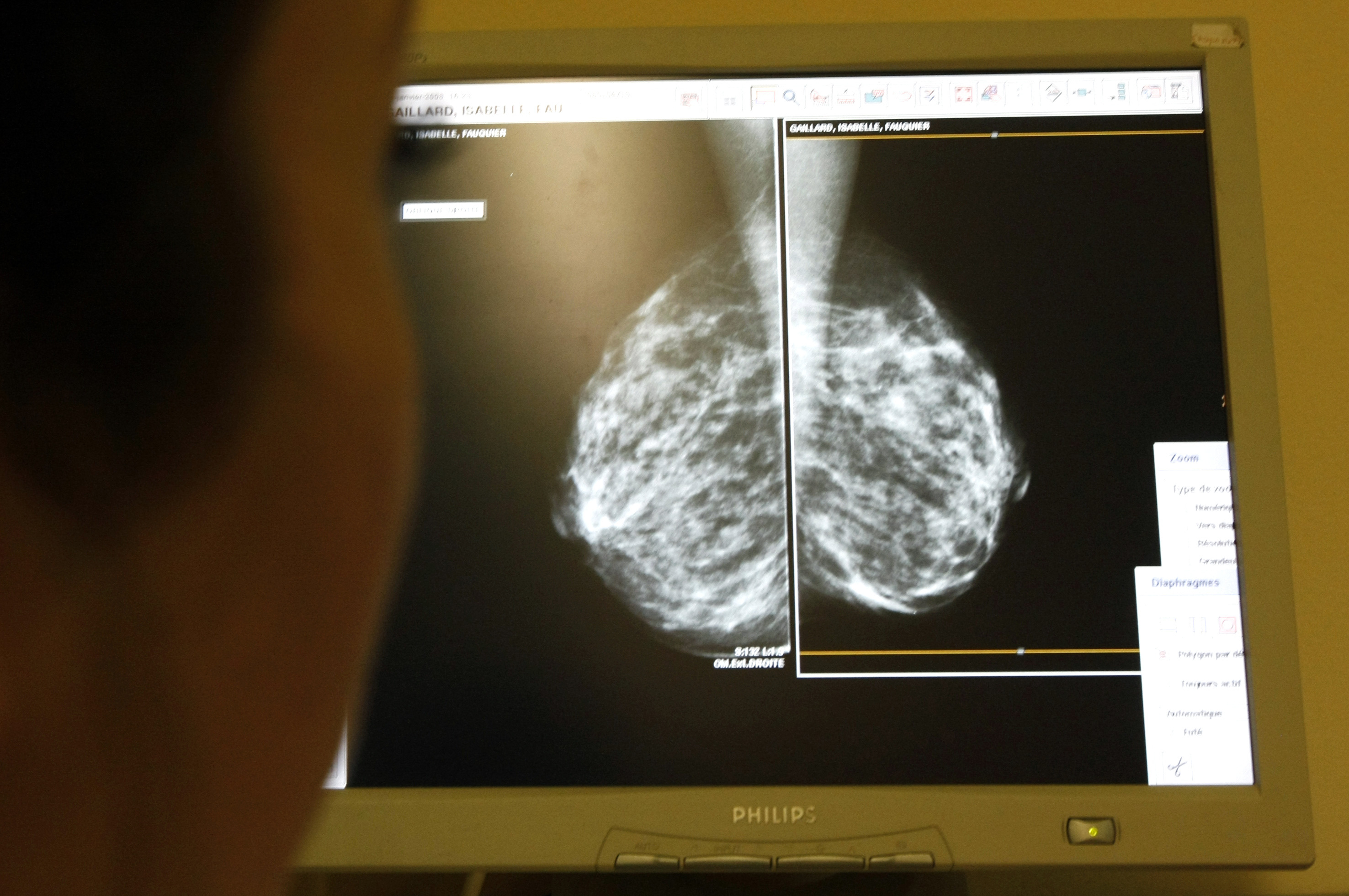 健康・医学 Preneoplasia of the Breast The breast pre-cancer atlas illustrates the molecular and