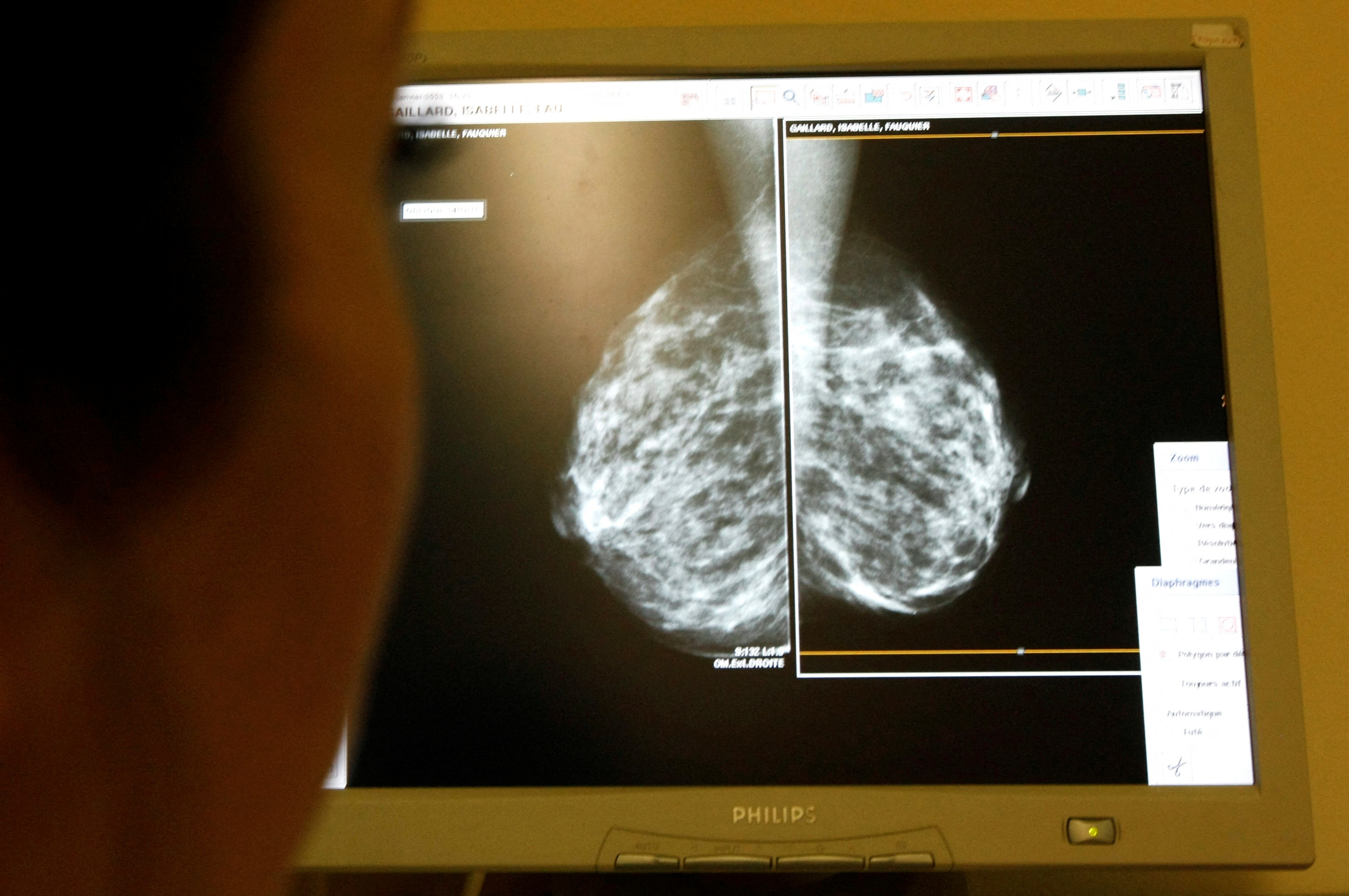 A doctor exams mammograms, a special type of X-ray of the breasts, which is used to detect tumours as part of a regular cancer prevention medical check-up at a clinic in Nice