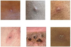 Pictures showing examples of rashes and lesions caused by the monkeypox virus