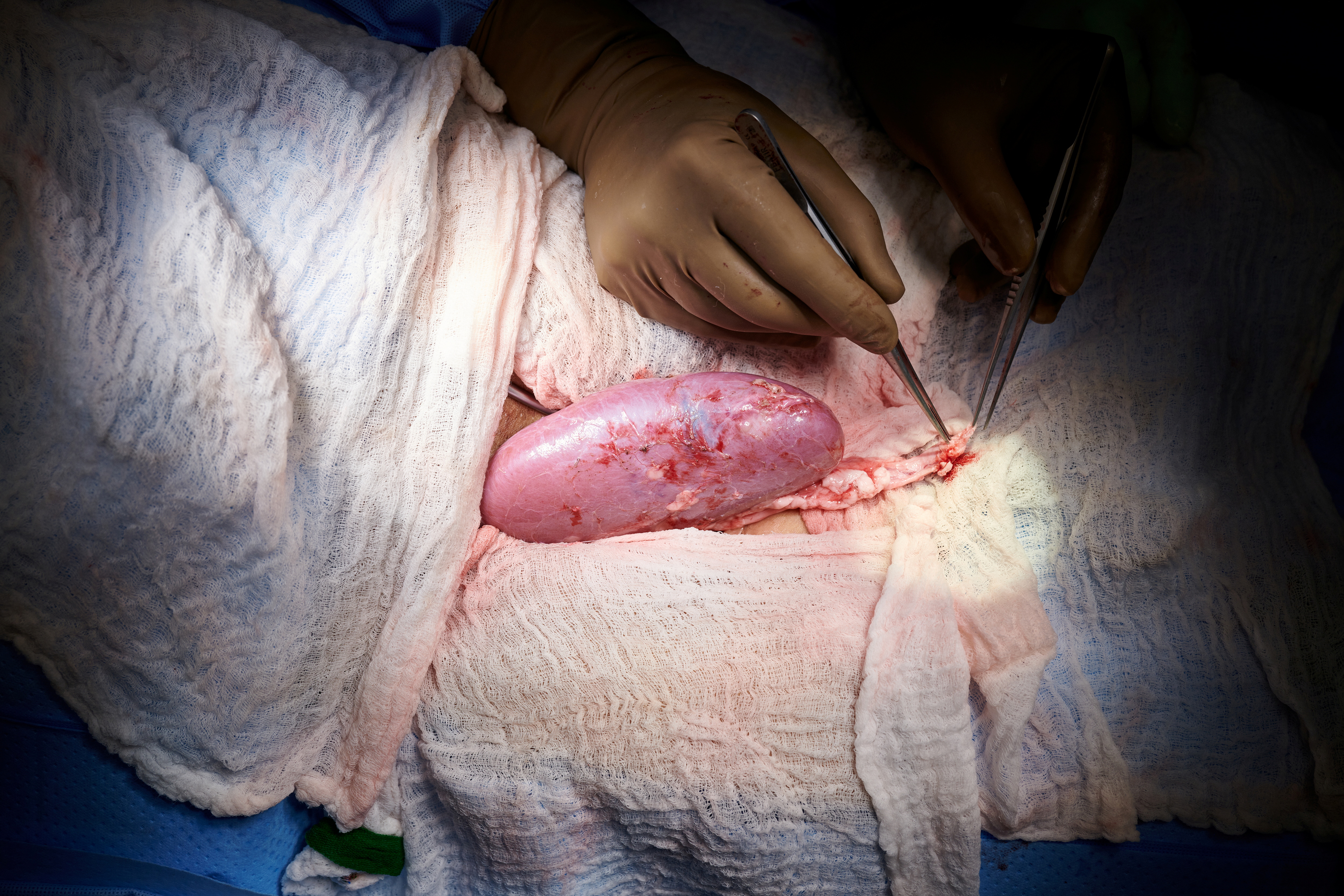 A genetically engineered pig kidney appears healthy during a transplant operation at NYU Langone in New York, U.S., in this undated handout photo. Joe Carrotta for NYU Langone Health/Handout via REUTERS  .