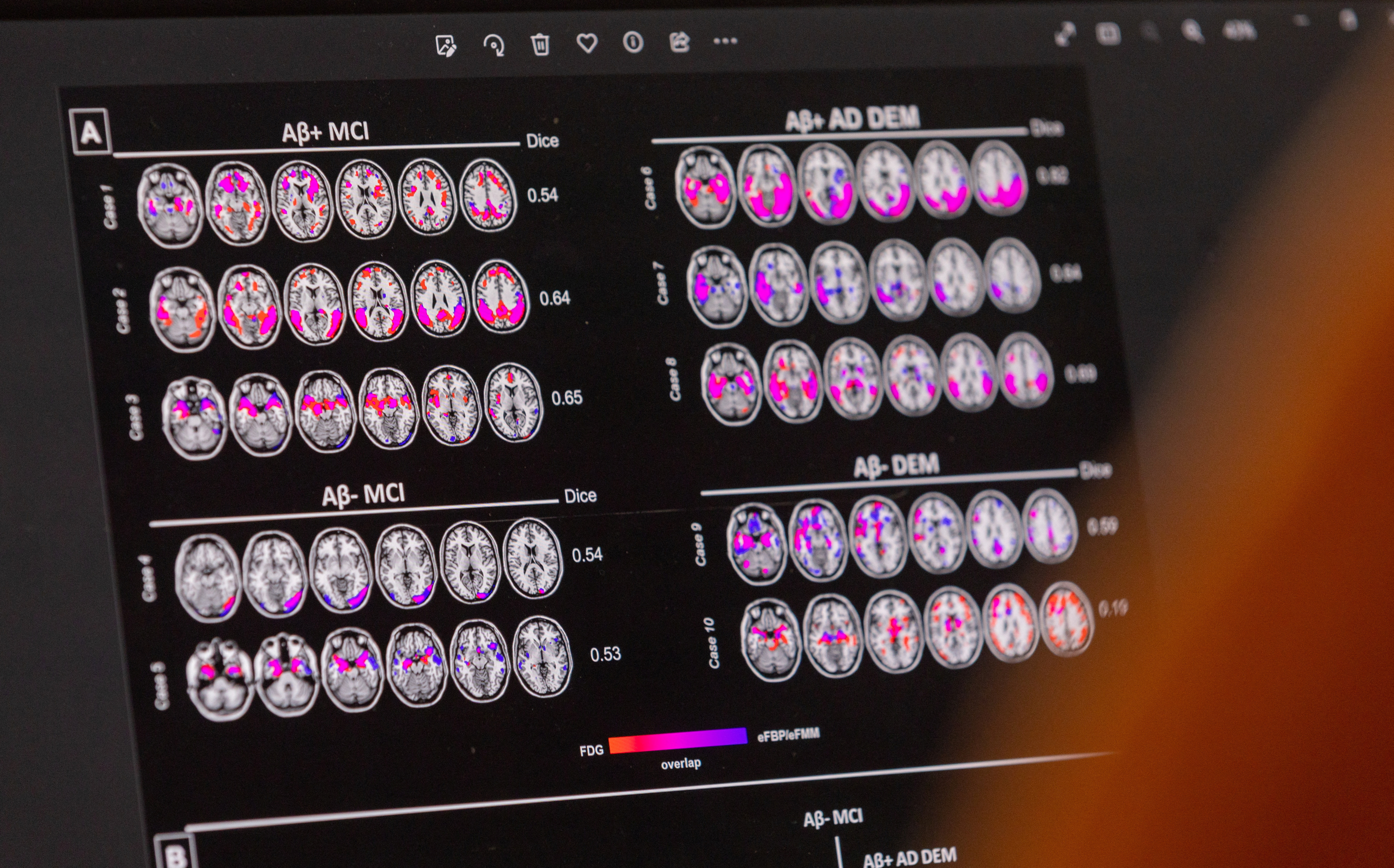 A scientist looks at hypometabolic and hypoperfusion patterns at the single-subject level from a patient suffering from Alzheimer's disease at the Memory Centre at the Department of Readaptation and Geriatrics of the University Hospital (HUG) in Geneva