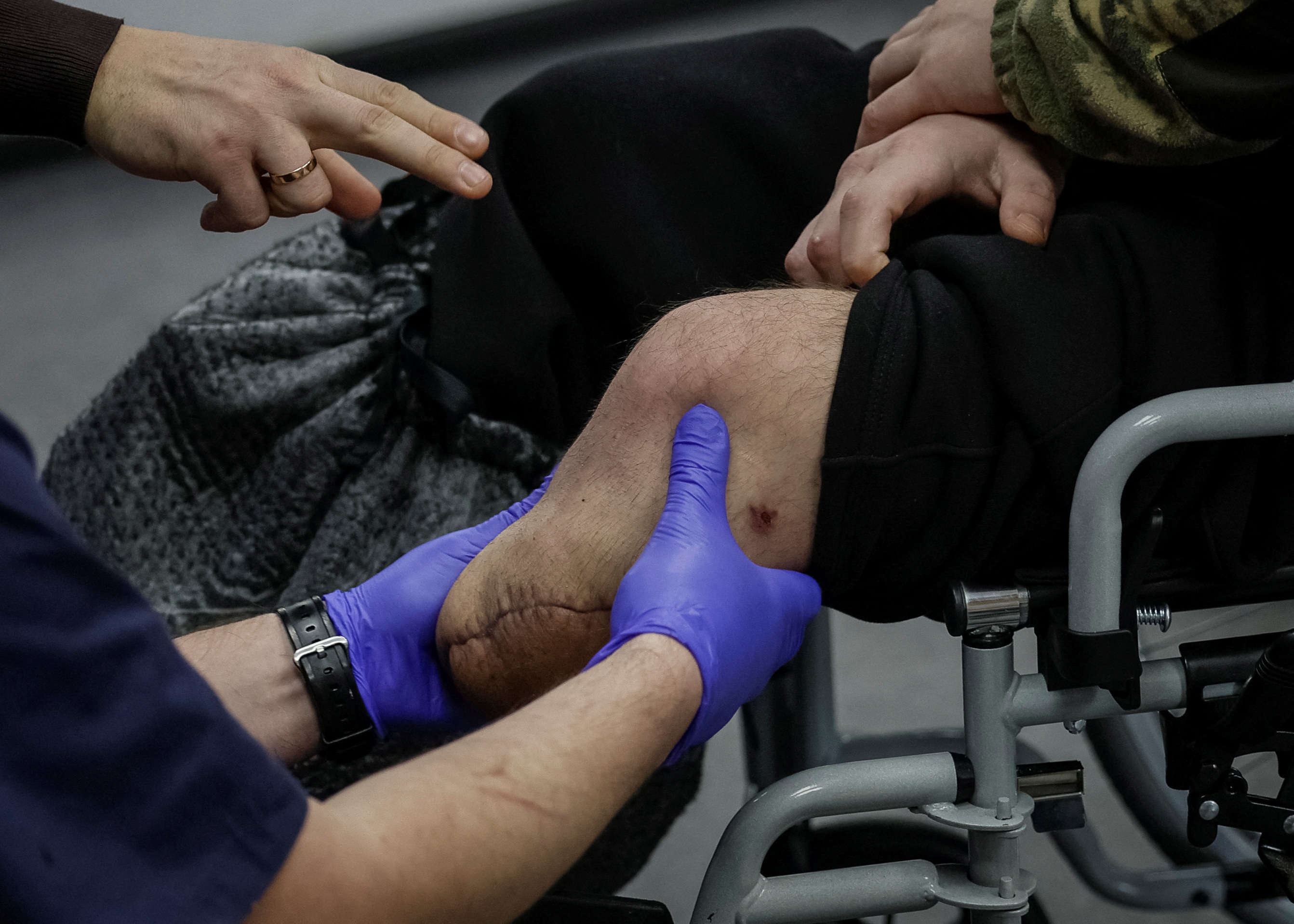 A worker of a prosthetics clinic examines an amputated limb of Denys, a soldier, who lost his leg at the war, on an appointment in the clinic in Kyiv