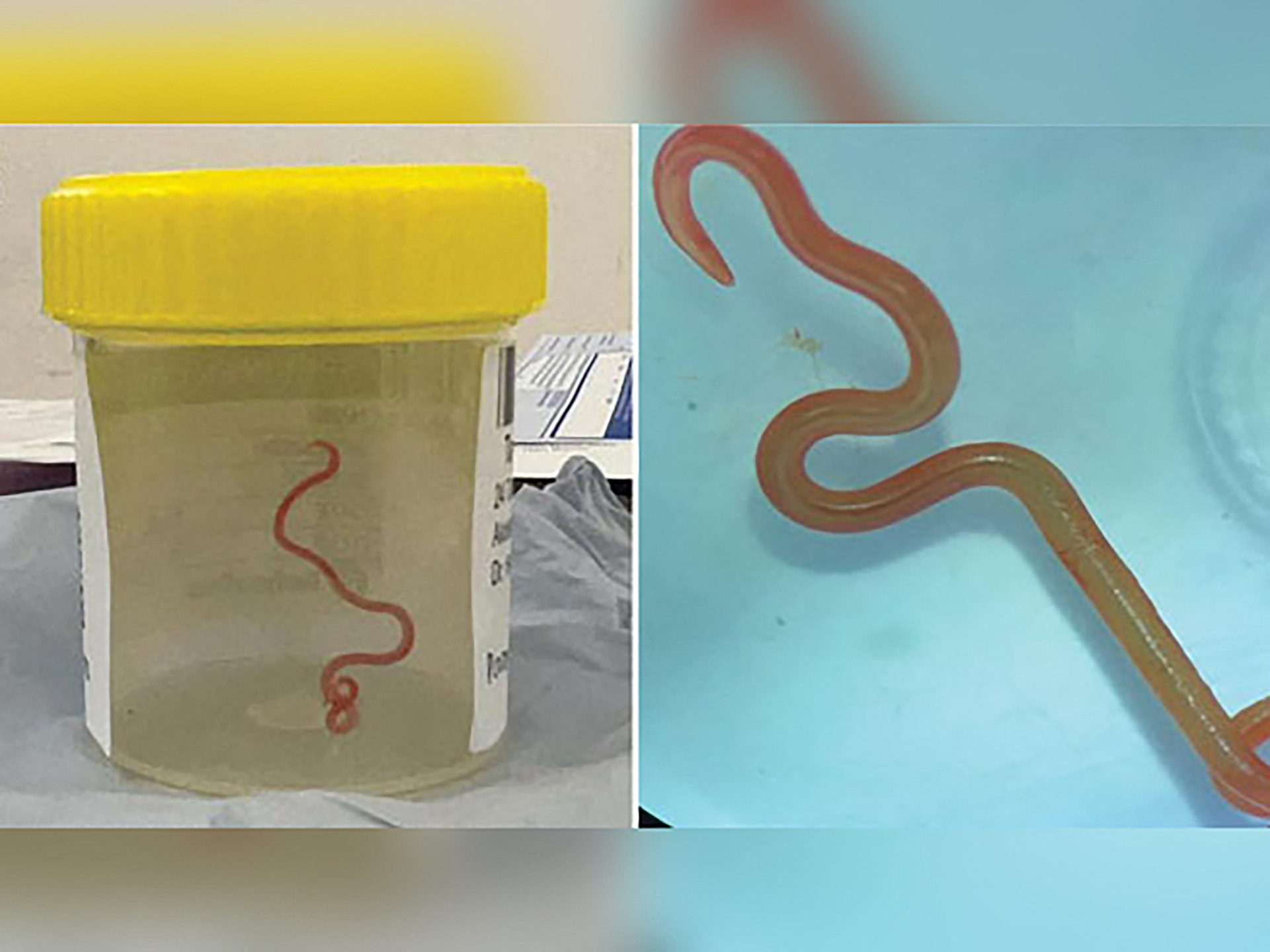 Combination photo of roundworm found in Australian woman’s brain