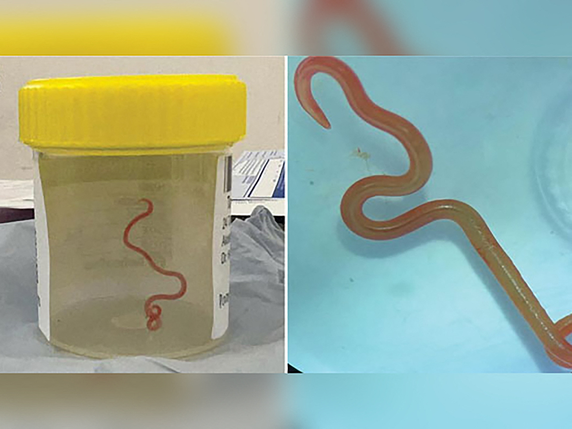 Live Parasitic Worm Found In Australian Woman's Brain In World