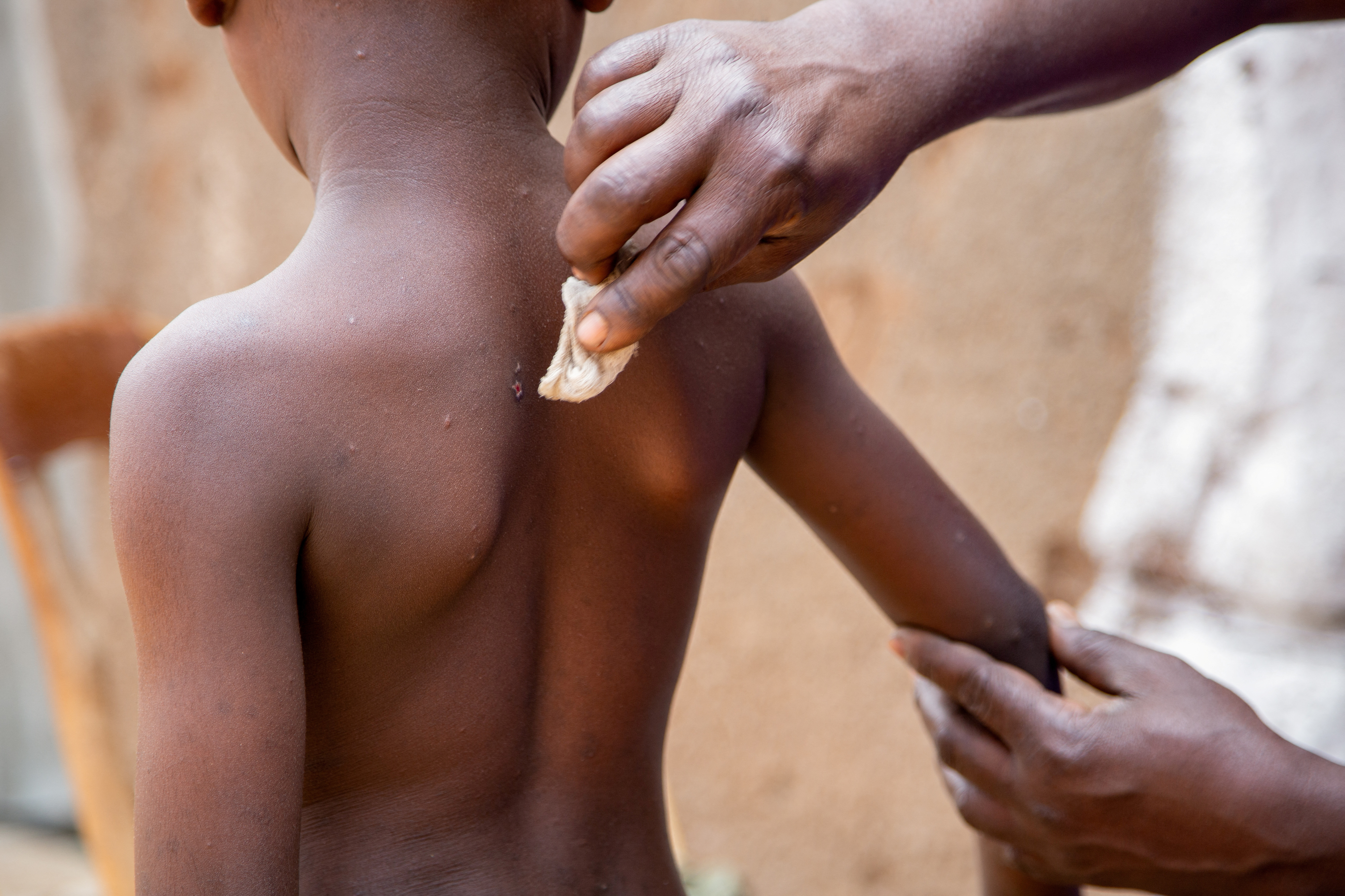 Mpox survivors return home after recovering in Kinama zone, in Bujumbura