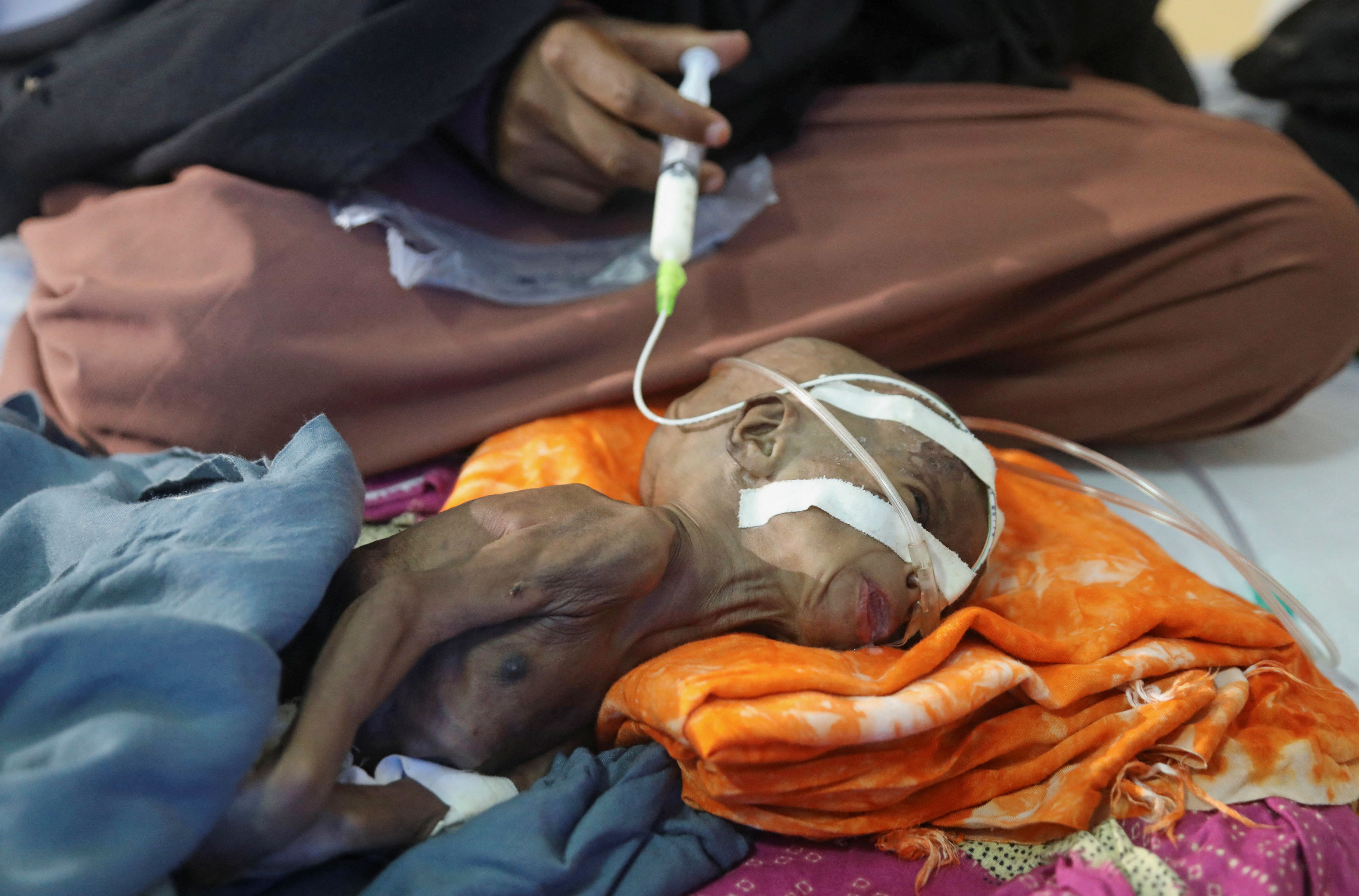 Zamzam Jamac, a Somali woman displaced by the worsening drought due to failed rain seasons, feeds her child Fatuma Botan, 1, through a nasogastric tube at the paediatric ward in the Banadir Hospital, in Mogadishu