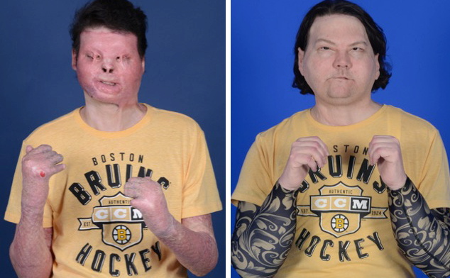 Lucky To Be Alive Owner Of New Face Hands Learns To Feel Life Anew Reuters