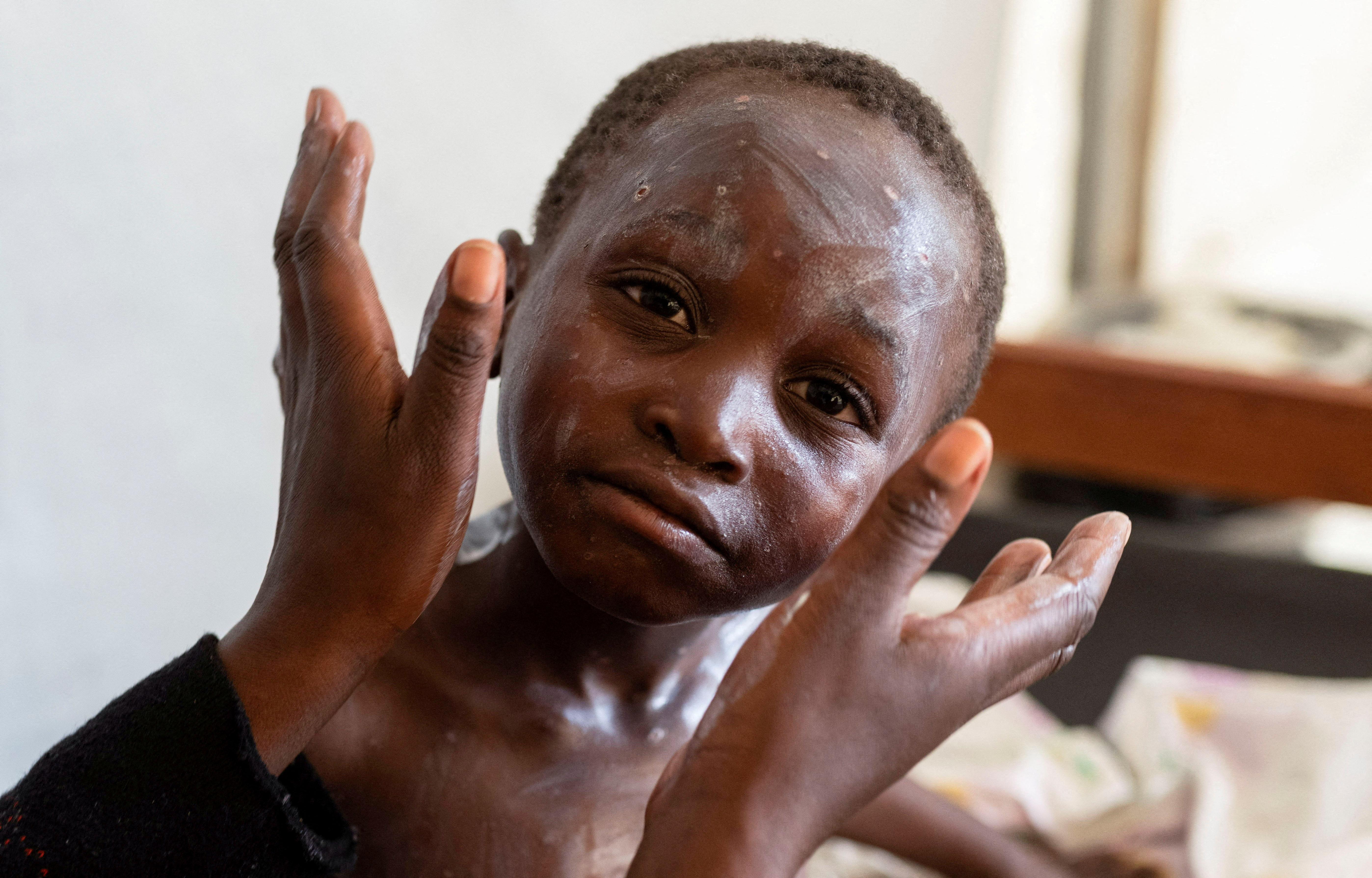 Mpox surge in Central Africa exposes awareness gap