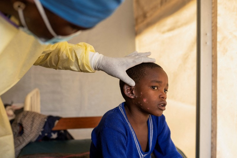 A child suffering from mpox in Democratic Republic of Congo