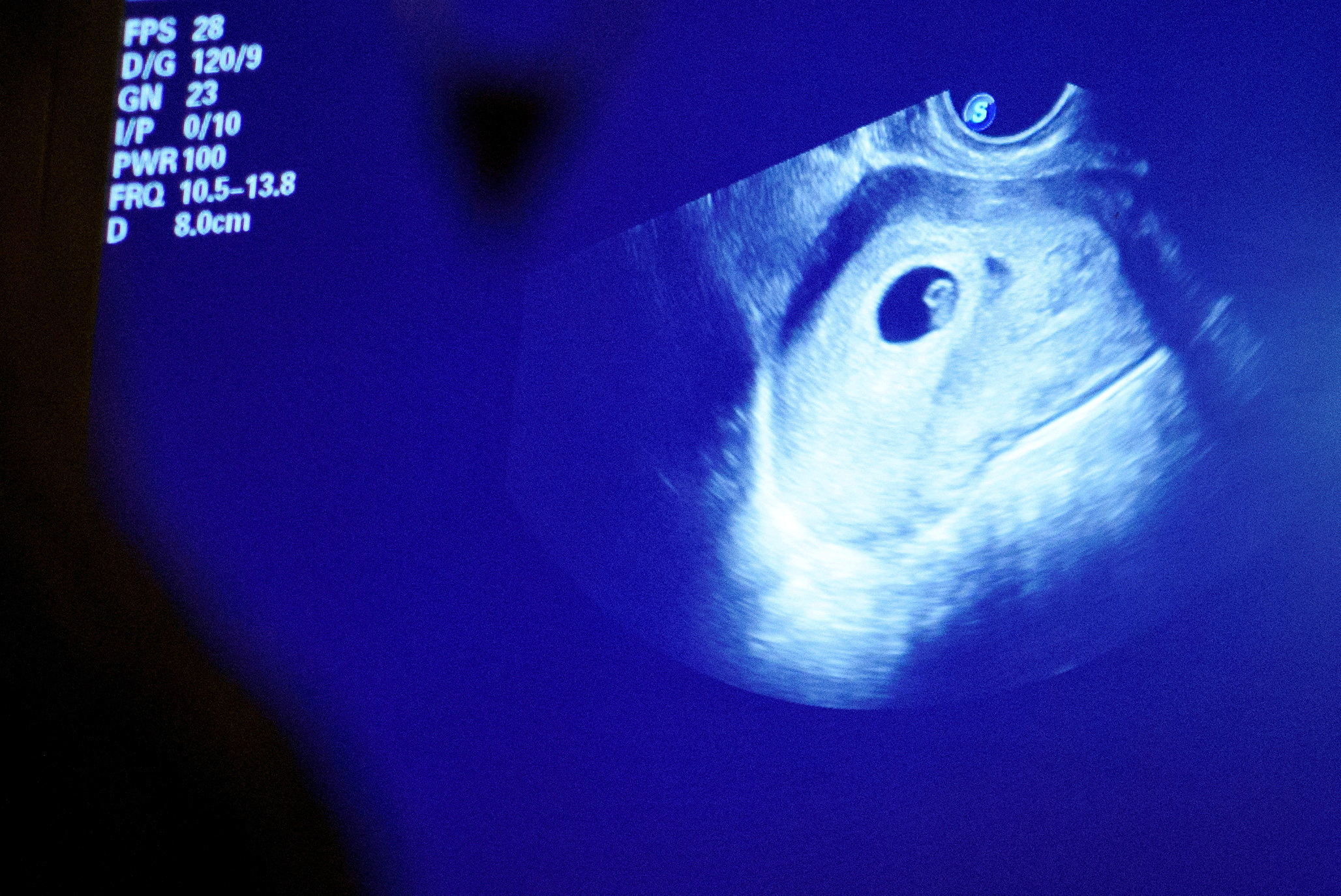 An ultrasound is taken ahead of a surgical abortion in Missoula, Montana