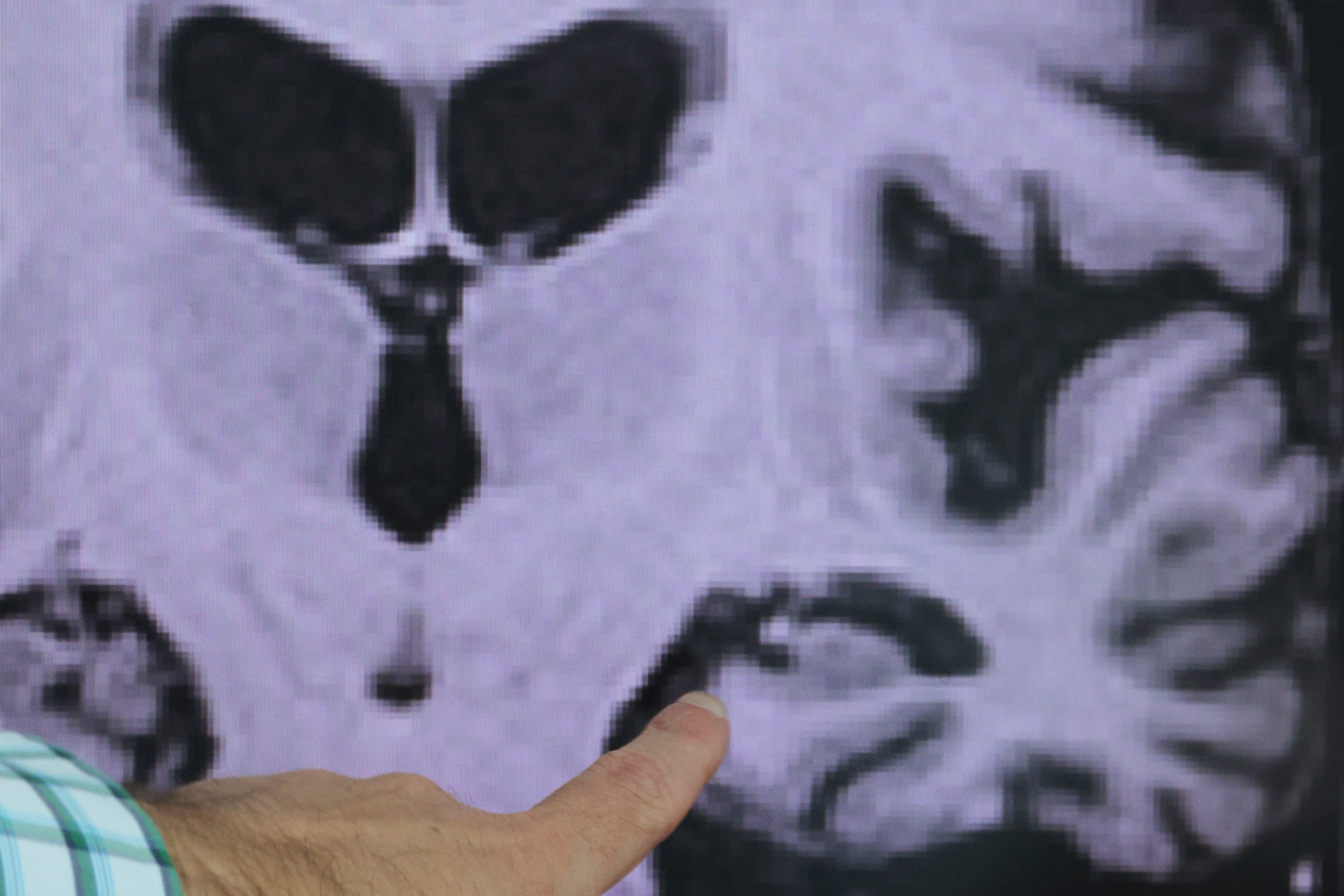 Evidence of Alzheimer’s disease on PET scans at the Center for Alzheimer Research and Treatment in Boston